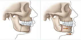 Jaw Surgery Illustration