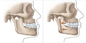 diagram of corrective jaw surgery