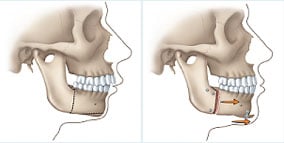 image of corrective jaw surgery
